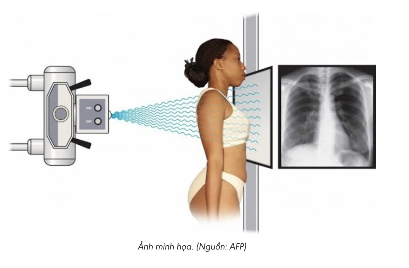 Nghiên cứu đầu tiên trên thế giới về ứng dụng AI trong chụp X-quang ngực